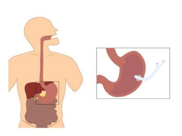 Enteral Nutrition Products Advantages Fitness Magazine