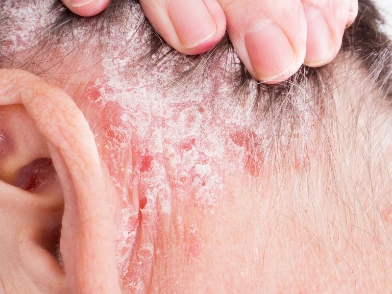 eczema chetorale del cuoio capelluto