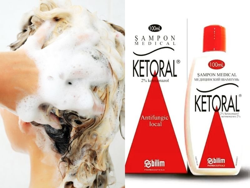 ketoral shampoo eczema
