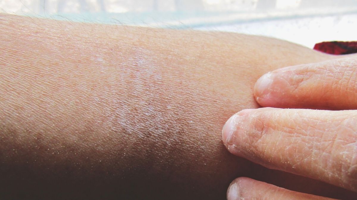 hvordan kurere tørr hud