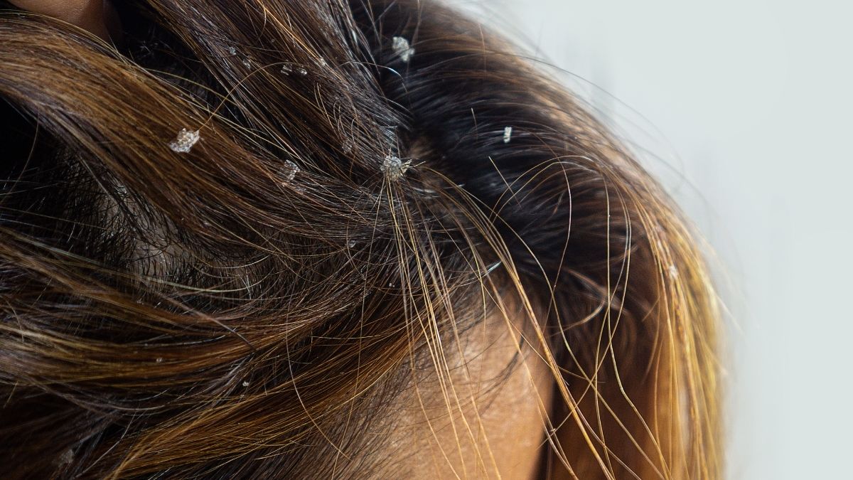 how to get rid of dandruff in hair