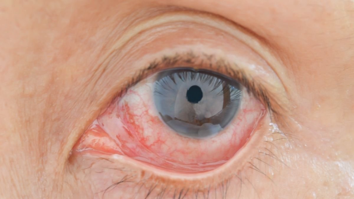 눈 알레르기의 증상은 무엇입니까?