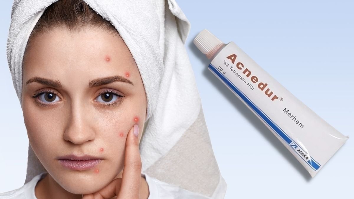 What are the benefits of acnedur cream?