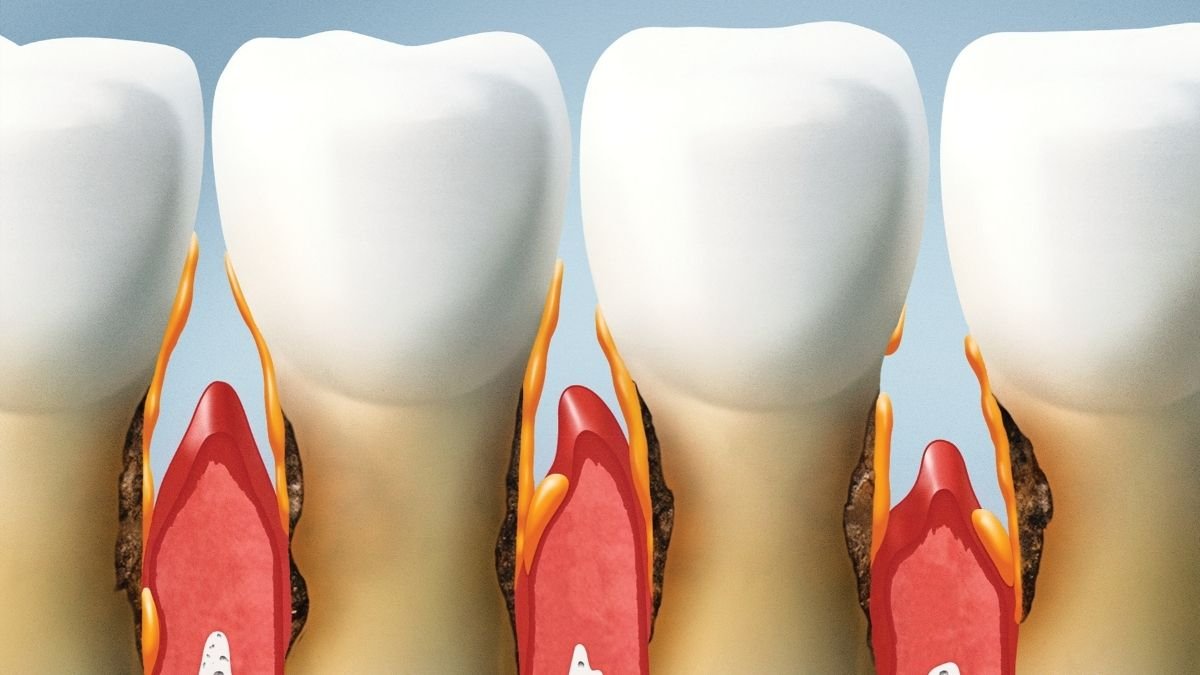 hvordan skjer tannkjøttresesjon