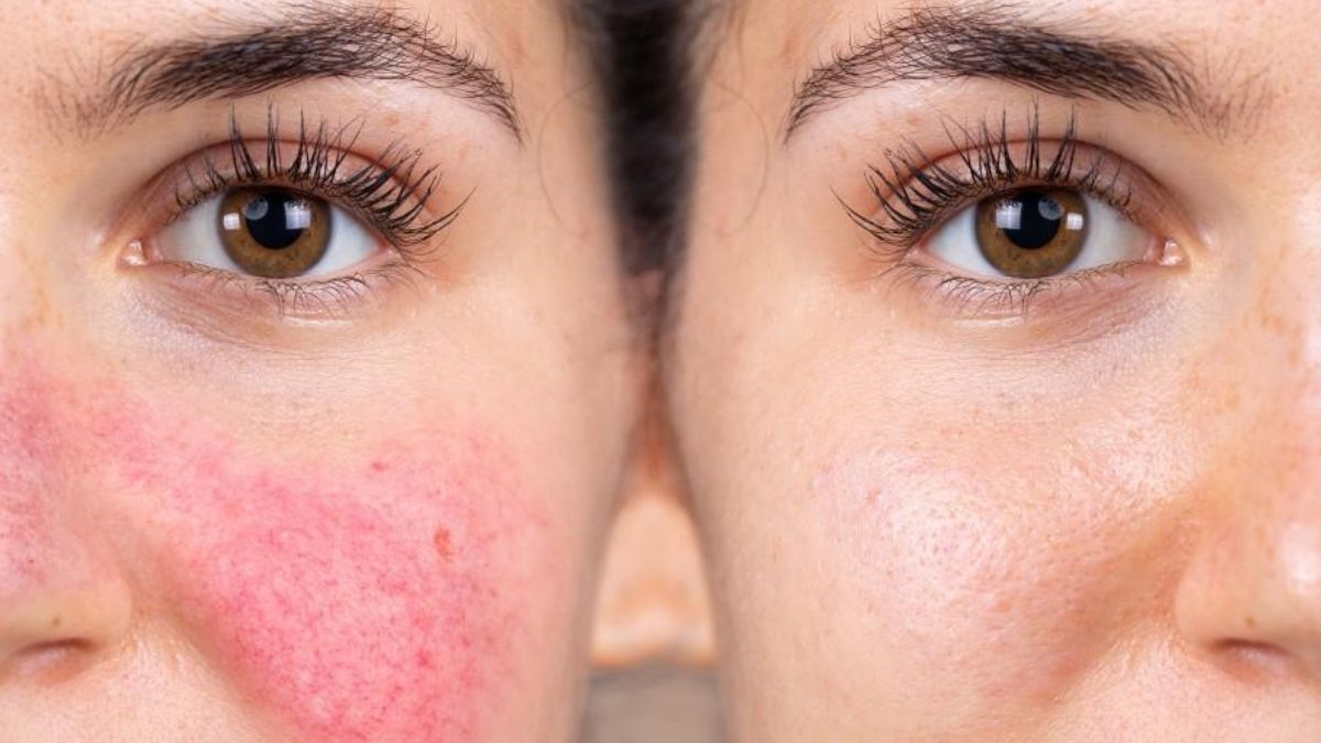 Causes of sudden redness on the face