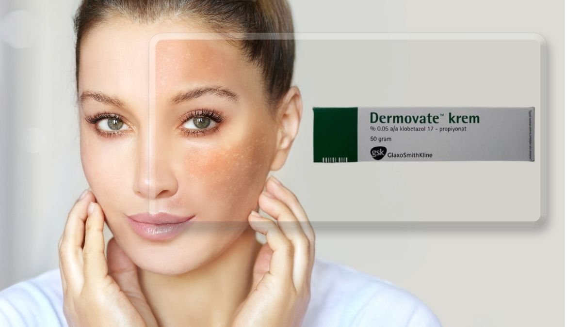 What does dermovate ointment do?