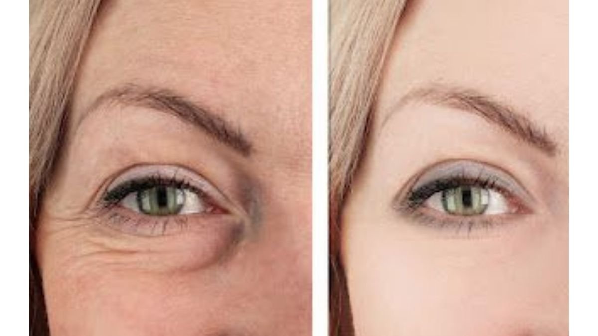 před a po operaci váčků pod očima