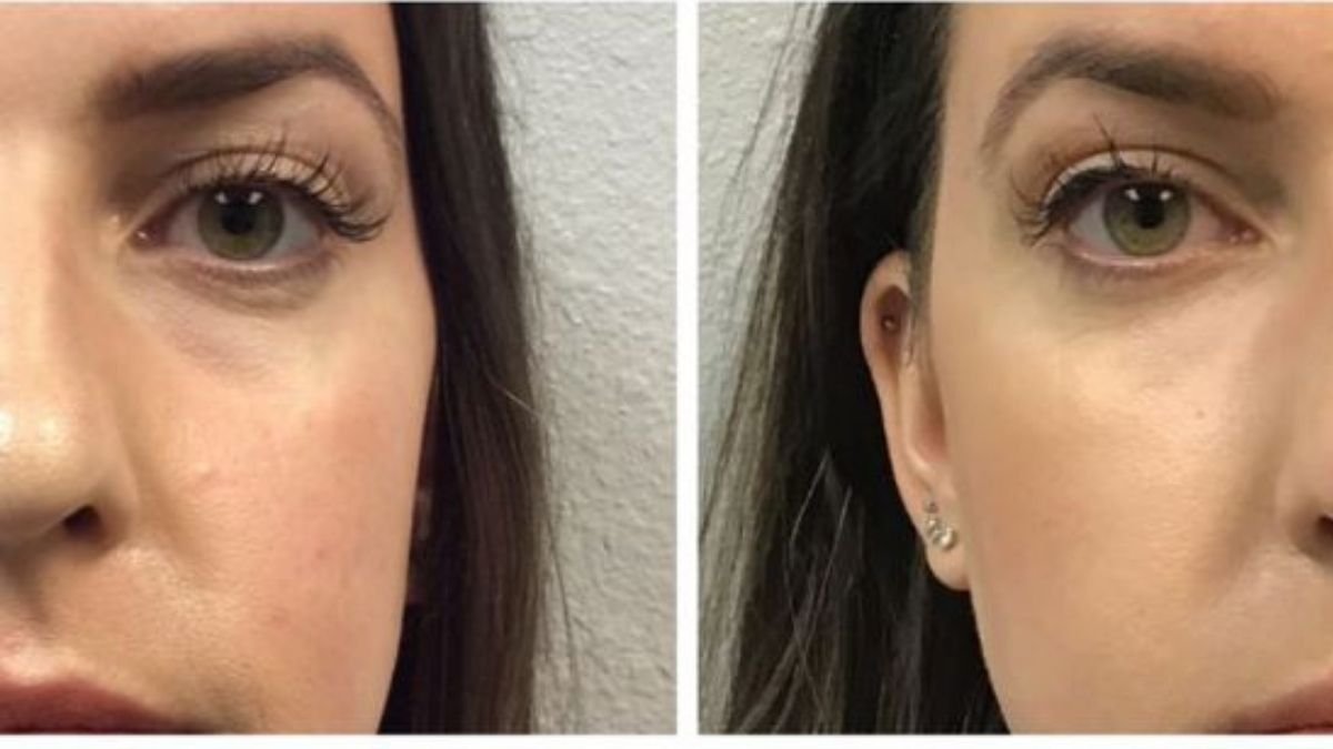 before and after under eye bag surgery