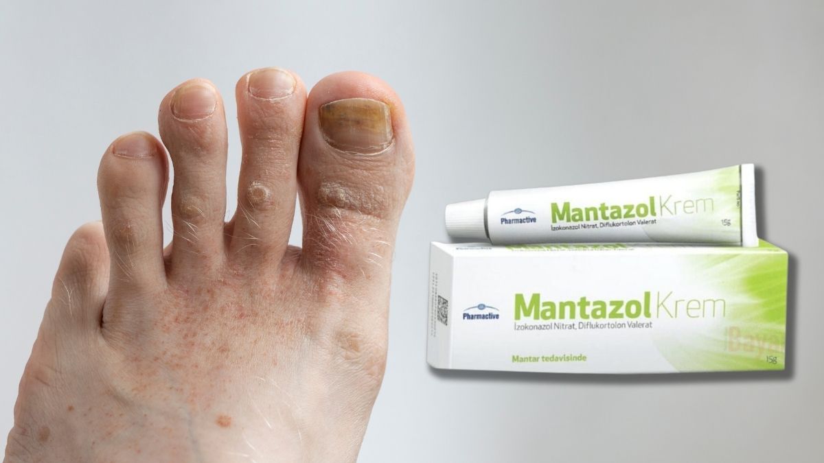 Was ist Mantazol-Creme – was es bewirkt – was sind die Nebenwirkungen