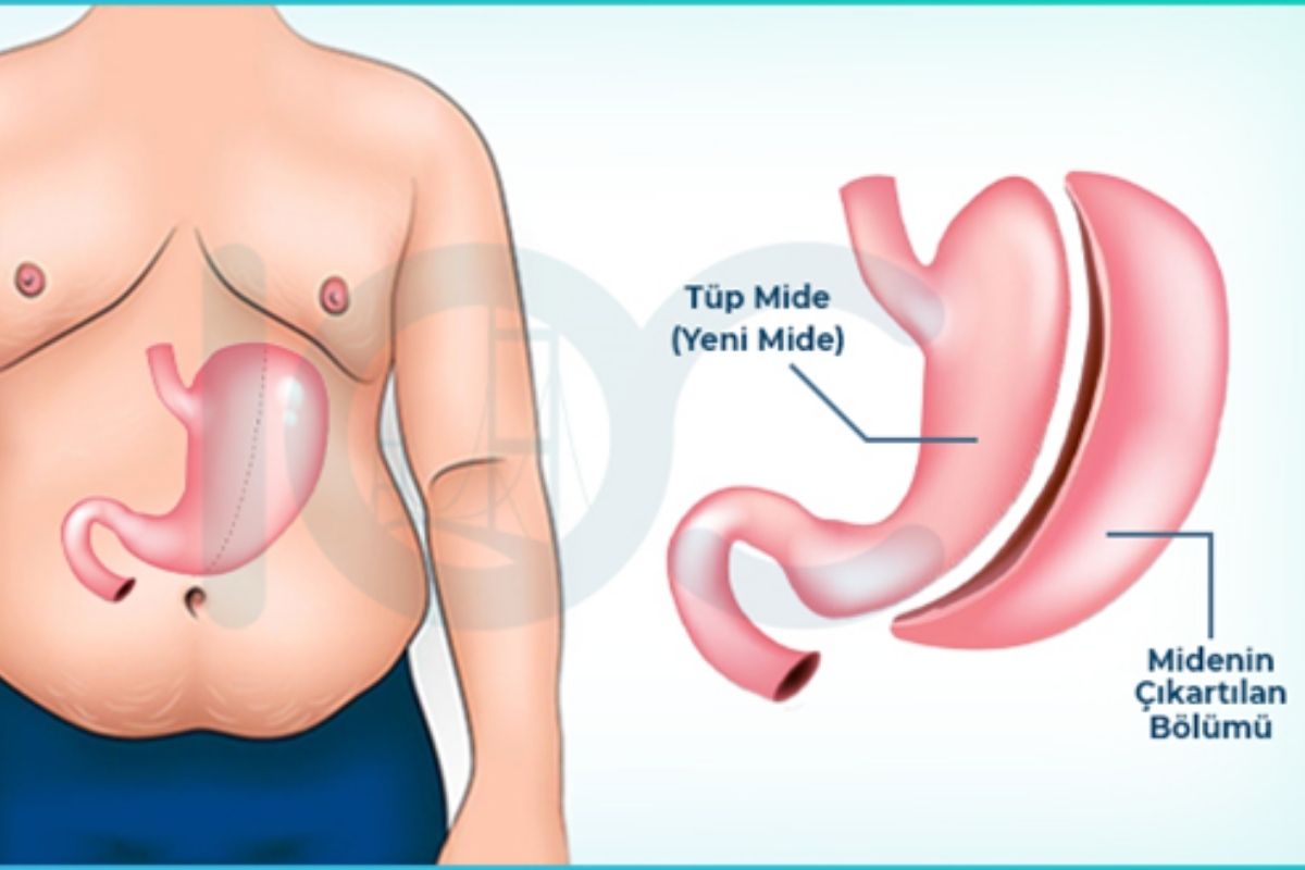 Est-il possible de perdre du poids avec la chirurgie ?