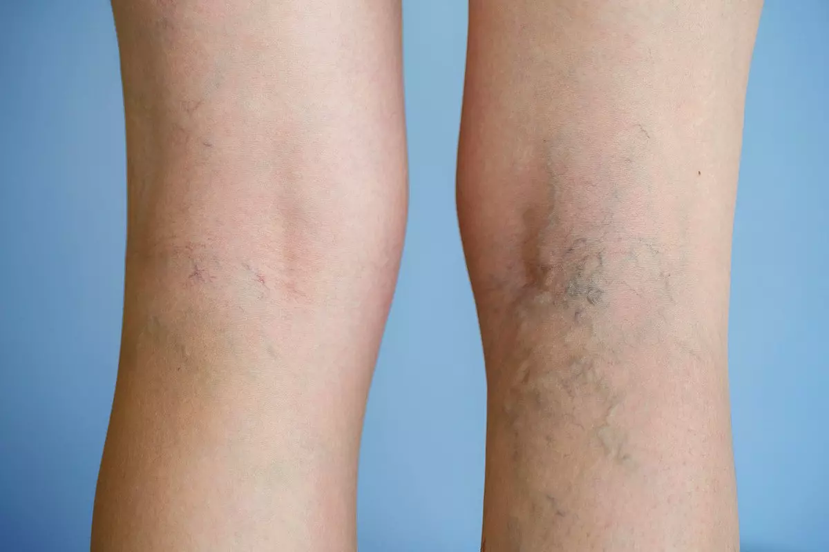 Which Doctor Should You See for Varicose Veins?