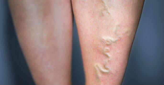 Which Doctor Should You See for Varicose Veins?